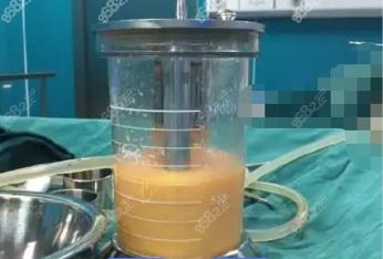 新乡360度水动力吸脂费用多少钱？