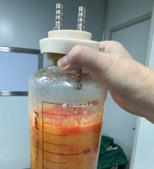 新乡水动力吸脂手术要做多久？